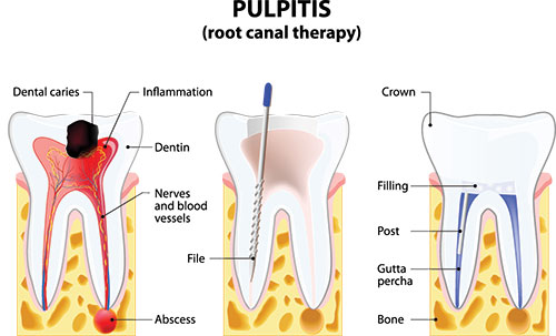Murphy Dentistry | Crowns  amp  Caps, Dental Fillings and CBCT