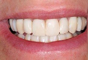 Murphy Dentistry | Preventative Program, Periodontal Treatment and Extractions