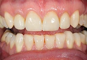 Murphy Dentistry | Preventative Program, Crowns  amp  Caps and Emergency Treatment